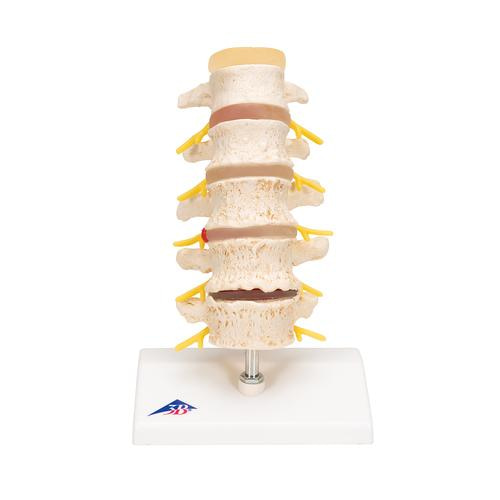 [3B] 5분리퇴행성척추모형 A795 (22cm/0.74kg) Stages of disc prolapse and vertebral degeneration