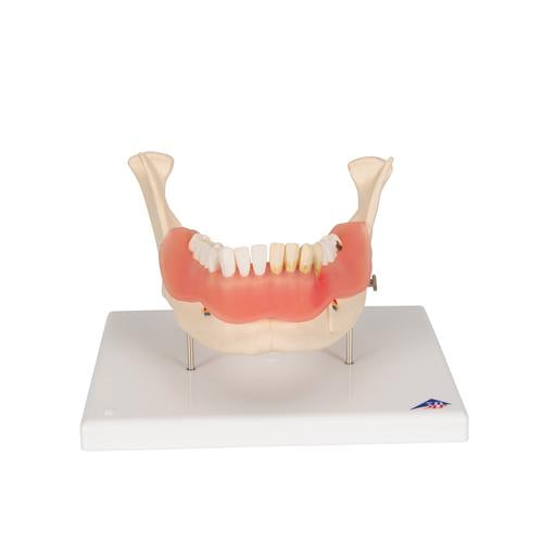 [3B] 2배확대 치석질환모형 D26 (17.5x26x18.5cm/1kg) Dental disease, magnified 2 times, 21 parts