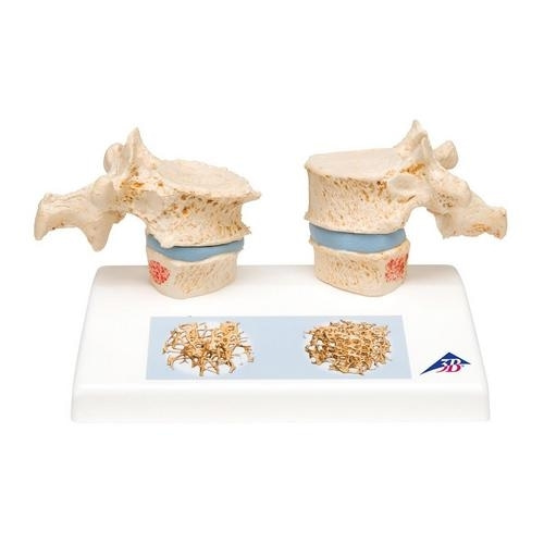 [3B] 골다공증모형 A95 (14x9x10cm/0.24kg) Osteoporosis Model