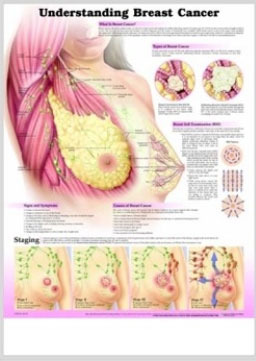 3D해부도(벽걸이)/ 9758B/유방암의 이해 Understanding Breast Cancer