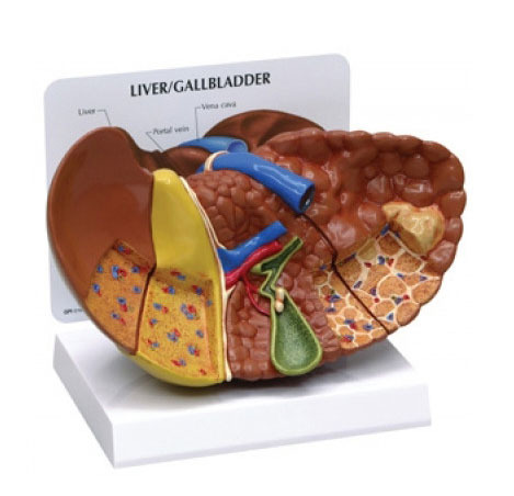 [GPI]간질환모형/G331/Diseased Liver 331/간모형