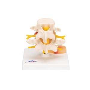 [3B] 2마디 요추모형 A76 (26x19x14.5cm/0.4kg) Lumbar Spinal Column with Prolapsed Intervertebral Disc