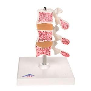 [3B] 골다공증모형 A78 (16cm/0.35kg) Deluxe Osteoporosis Model (3 Vertebrae)