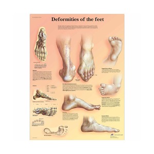 [독일3B] 발 기형차트 Deformities of the Feet Chart VR1185L(코팅) 인체해부도