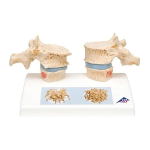 [3B] 골다공증모형 A95 (14x9x10cm/0.24kg) Osteoporosis Model