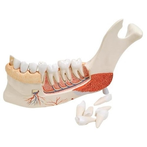 [3B] 19분리 병든치아모형 VE290 (22x32x9cm) 19-Part Advanced Half Lower Jaw with 8 Diseased Teeth
