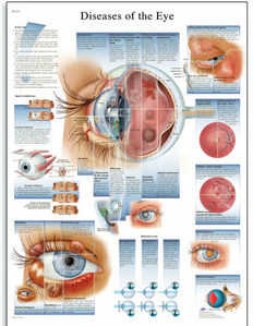 [독일3B] 안구 질병차트 안구질환 Diseases of the Eye Chart VR1231L(코팅) 인체해부도