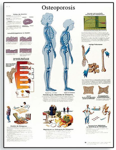 [독일3B] 골다공증차트 Osteoporosis Chart VR1121L(코팅) 인체해부도