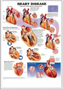 3D해부도(벽걸이)/9912 /심장질병( HEART DISEASE )
