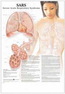 3D해부도(벽걸이)/ 9784/중증급성호흡기증후군  SARS