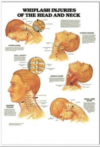 3D해부도(벽걸이)/ 9989/머리와 목의 반복성 긴장장애차트(WHIPLASH INJURIES OF THE HEAD AND NECK)