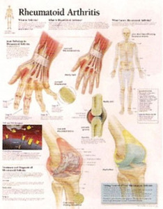 평면해부도(벽걸이)/ 1152 /류마티스관절염 Rheumatoid Arthritis / 사이즈   56cm ⅹ 71cm Paper