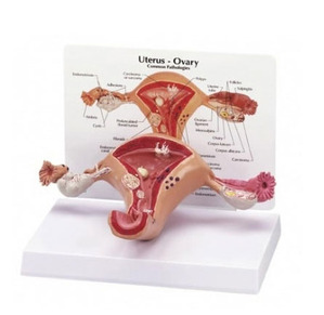 [GPI]자궁모형/G348/자궁질환모형/자궁구조모형
