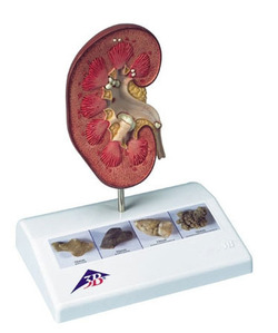 [3B] 신장결석모형 K29 (14x10x16.5cm/0.3kg) Kidney Stone Model