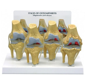 [GPI] 4단계 관절염(G110)/ 4-Stage Osteoarthritis Knee 110