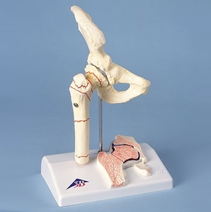 [3B] 대퇴부골절 및 고관절염모형 A88 (14x10x22cm/0.4kg) Femoral Fracture and Hip Osteoarthritis